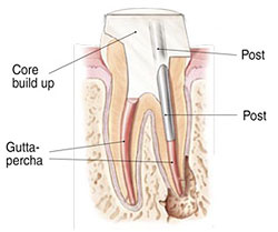Endodontic Treatment